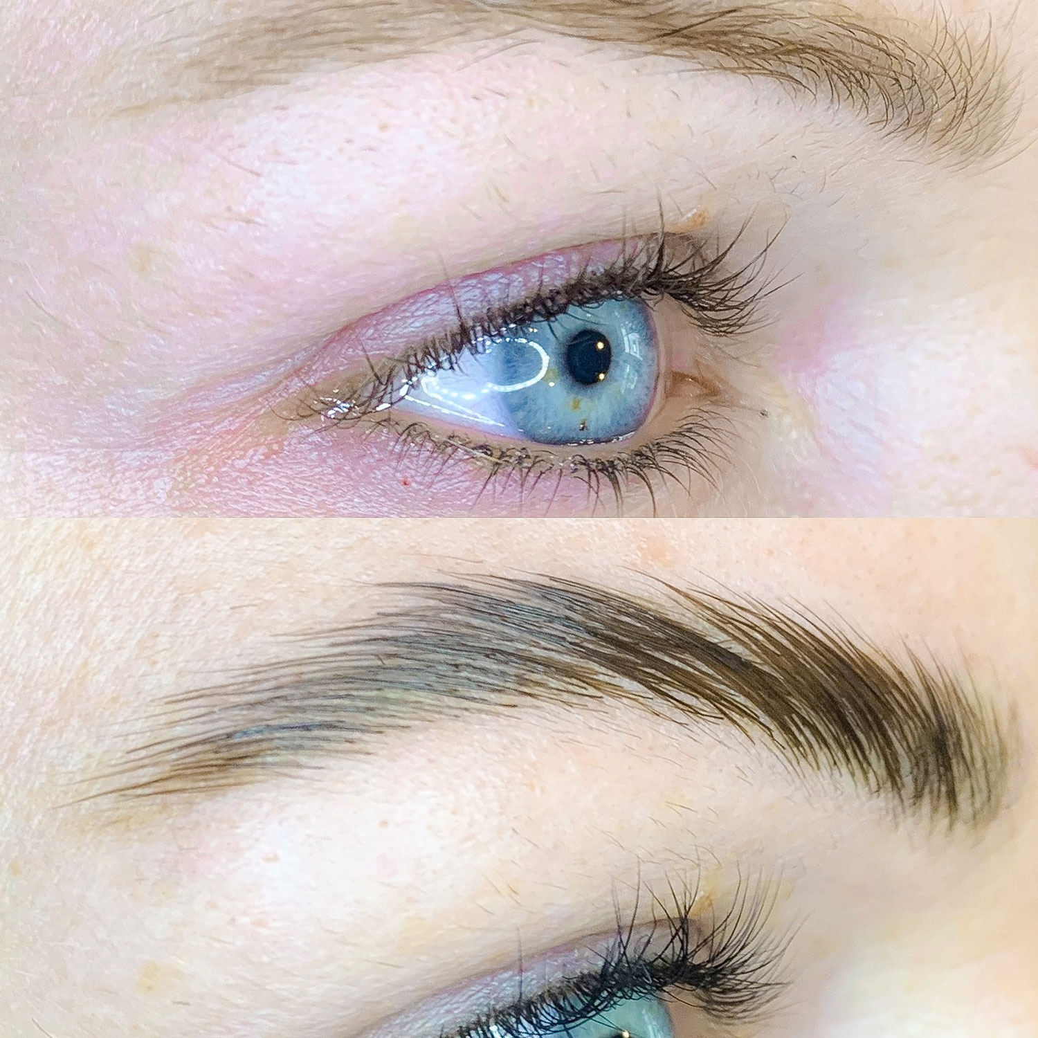 Brow Lifting – Bild 2