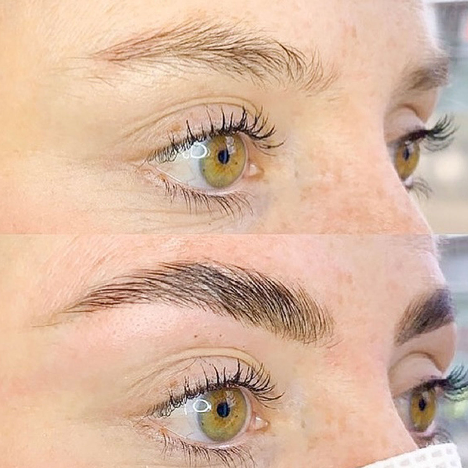 Brow Lifting – Bild 6